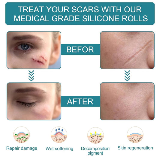 Painless Silicone Scar Removal Tape ( Buy 1 Get 1 Free )