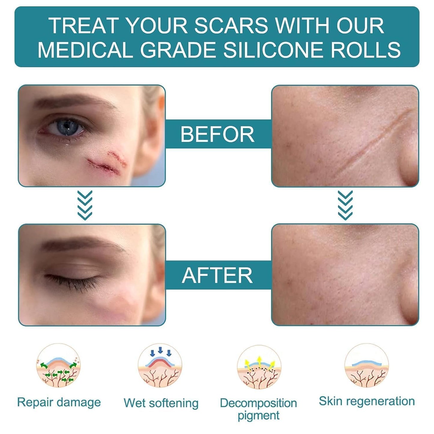 Painless Silicone Scar Removal Tape ( Buy 1 Get 1 Free )